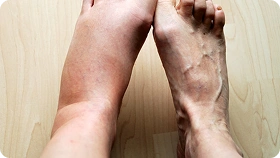 treatment
