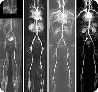 Whole Body Angiography